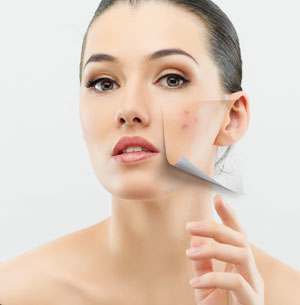 Acne Scar Treatment